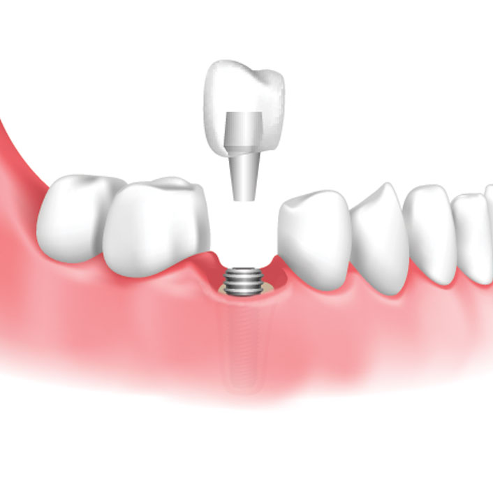 implant-restoration - Dental Services