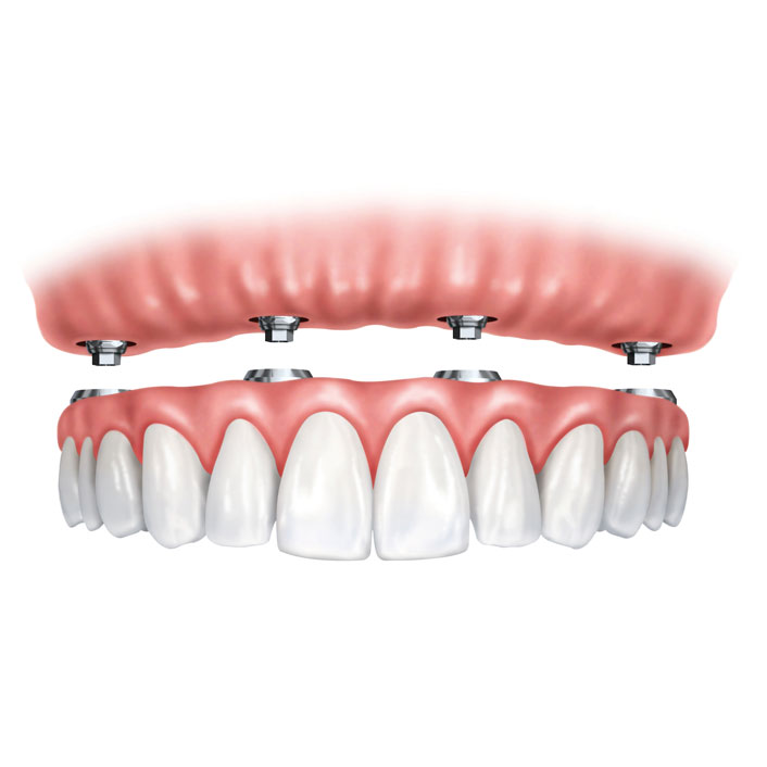 implant-dentures - Dental Services