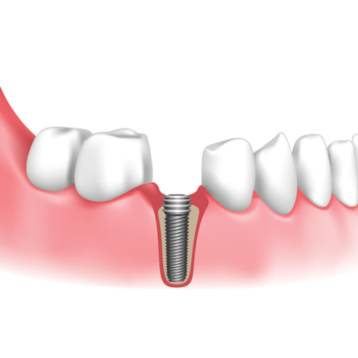implant-placement - Dental Services